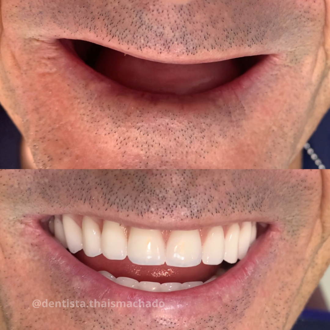 Caso clínico 1 antes e depois