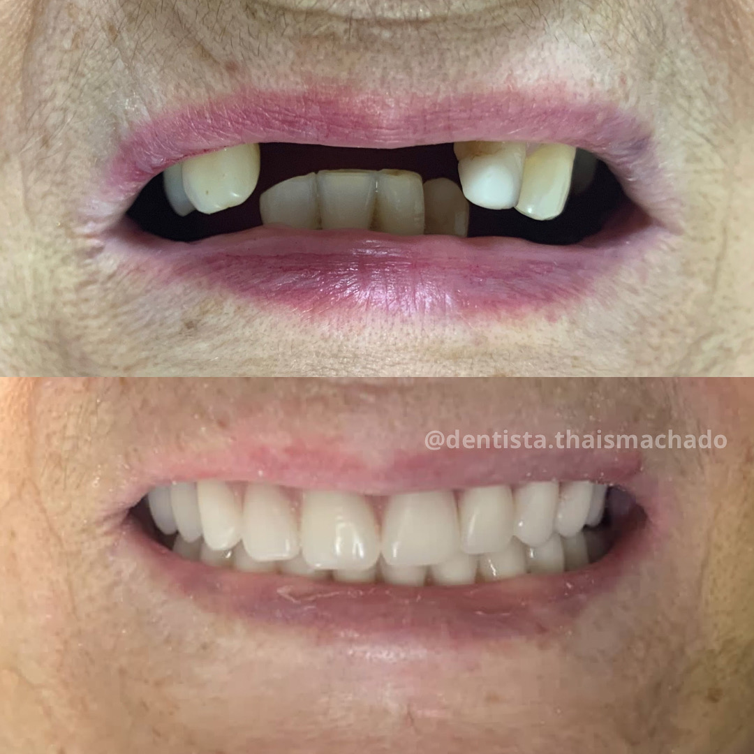 Caso clínico 3 antes e depois