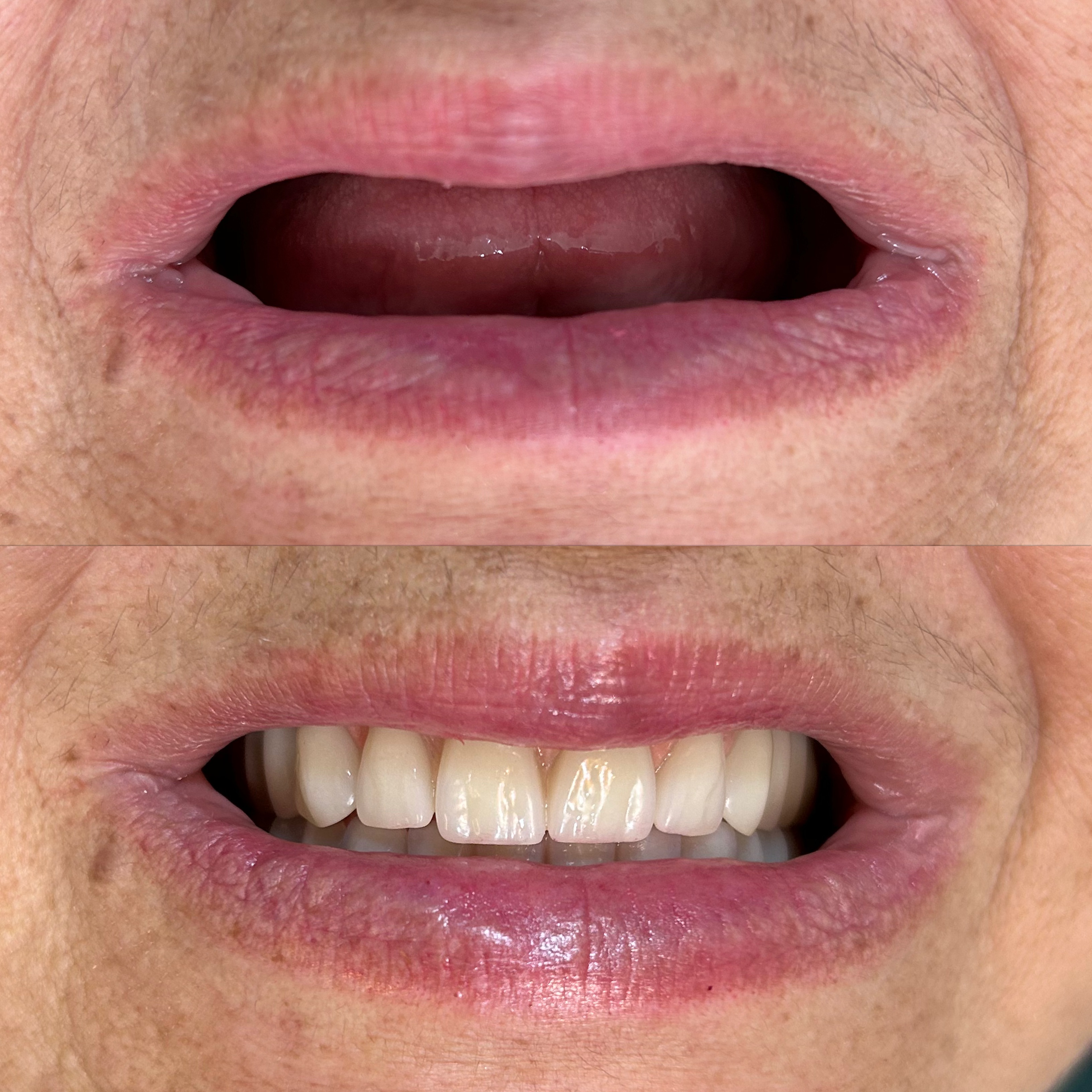 Caso clínico 5 antes e depois